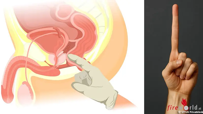 Prostatakrebsvorsorge-Abtasten-bringt-nichts-PSA-Test-und-MRT-setzen-sich-durch